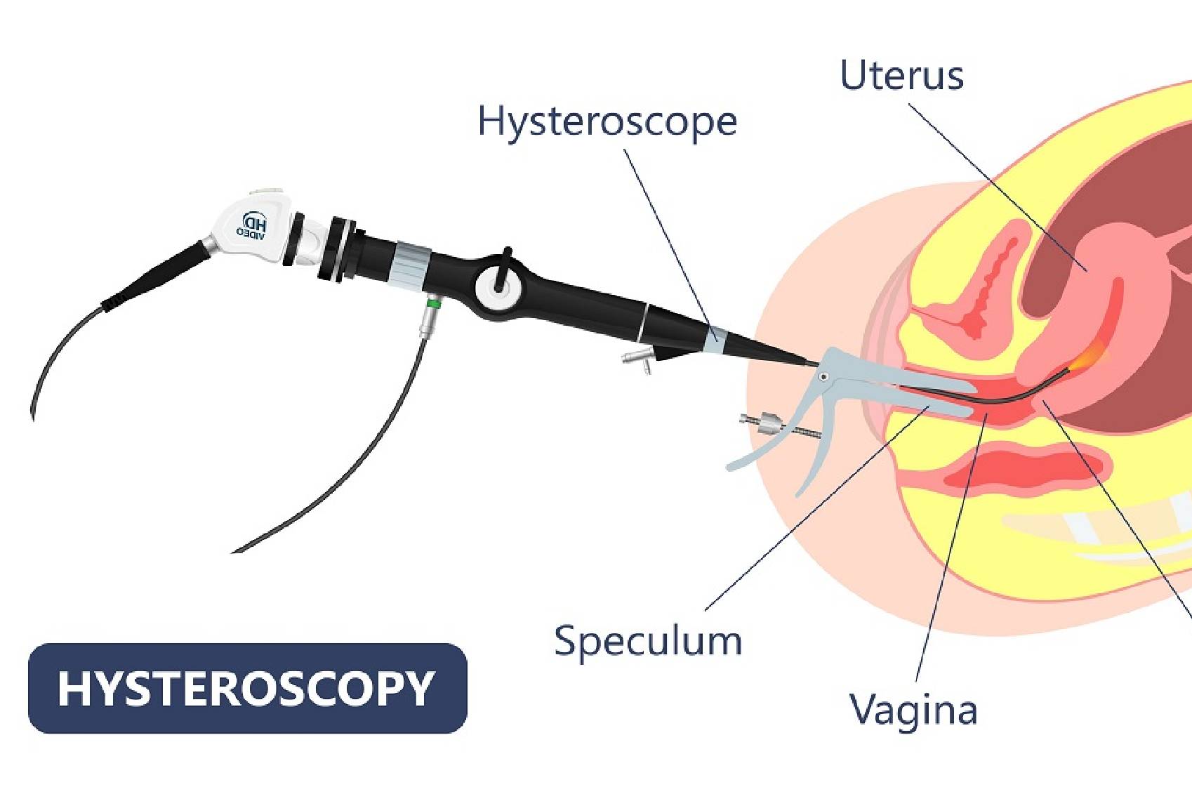 IVF specialist in Pune