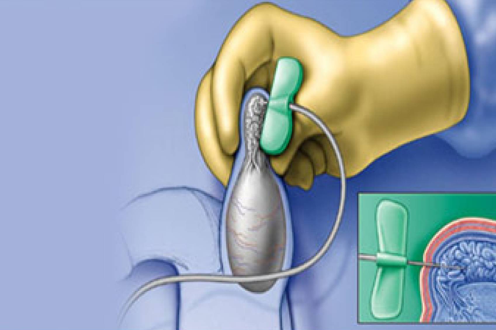 IVF specialist in Pune