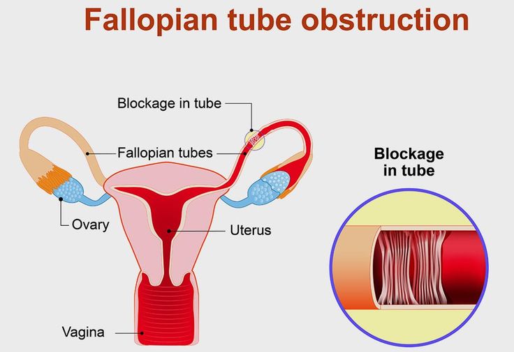 Blocked Tube Treatment in Pune