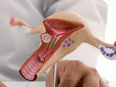IUI treatment