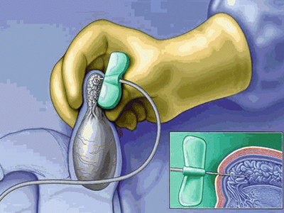 PESA Treatment